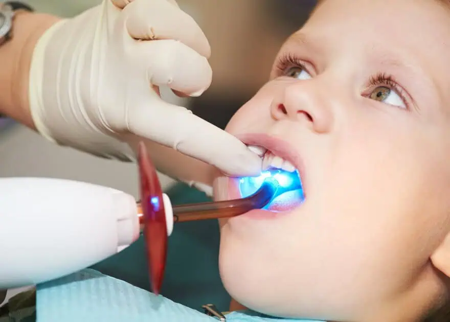 Dental Fillings by Solomon Kids Dentistry in Summerville, Sc